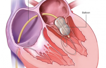 Ballon-Mitral-Valvoplasty1