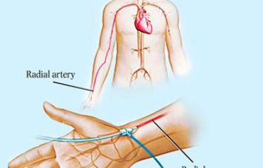 radial-artery-intervention-500x500-1